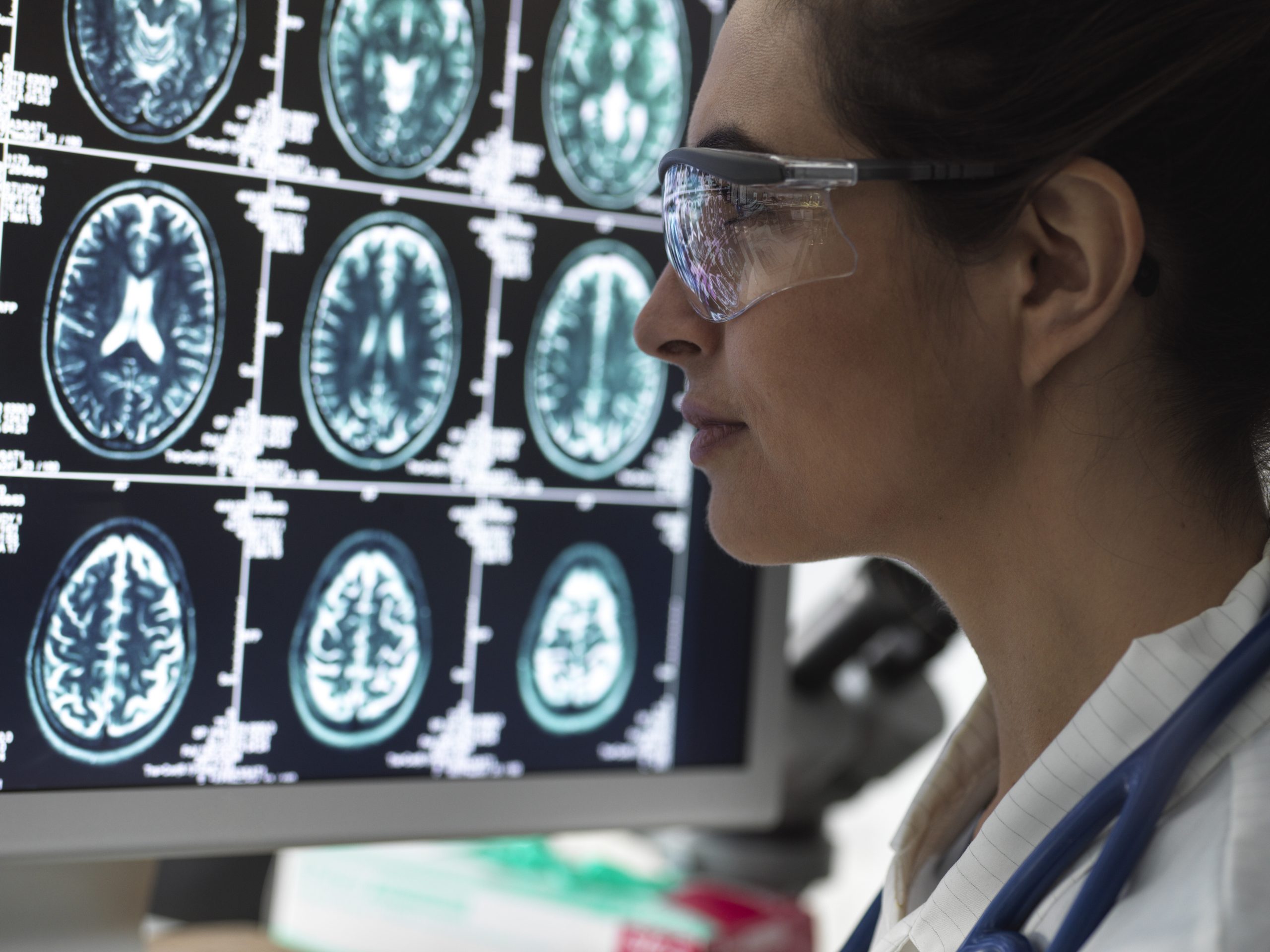 Nuovi criteri diagnostici della sclerosi multipla – interviste